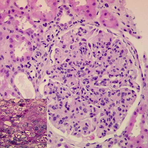 FIGURE 1. Renal biopsy (HE, 20× magnification). Glomerulus showing endocapillary proliferation, thickening of the capillary walls, and leukocytes infiltration. Inset: glomerular detail (PAS, 40× magnification) demonstrating intracapillary thrombi.