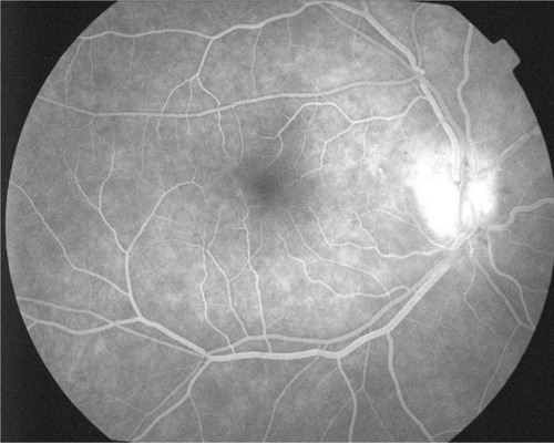 Figure 3 Fluorescein angiography shows diffuse leakage of the optic disc in the late phase.