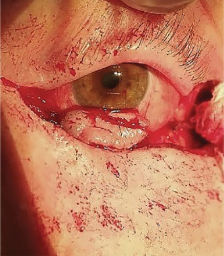 Figure 2. Medial transposition of an intact temporal part of the eyelid.