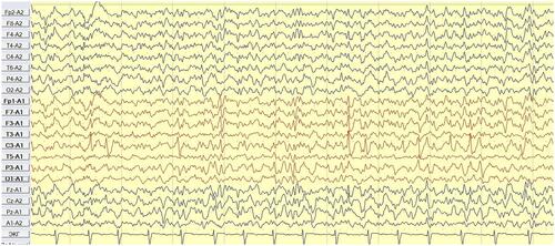 Figure 6 Case 2 - awake 5 y.o. (ipsilateral mastoid reference montage).