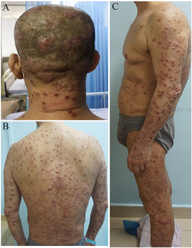 Figure 1 Clinical appearance of the skin lesion. (A) Scattered erythema and infiltrative plaques on the head, isolated and not fused. (B and C) Numerous papules and nodules on the patient’s trunk and limbs, with well-demarcated.