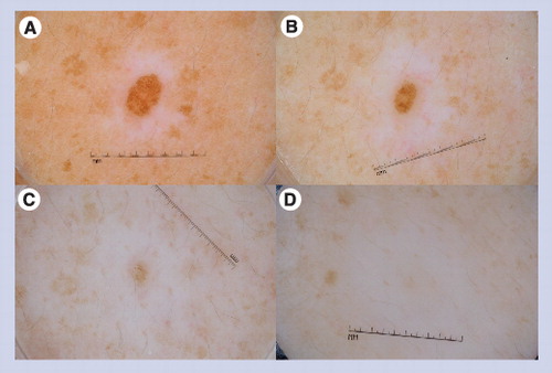 Figure 11. Halo nevus.This globular nevus is surrounded by a halo of depigmentation. This nevus became smaller over time and eventually disappeared over the course of a 4-year period. The first image (A) was obtained at baseline, the second image (B) at the 1-year follow-up visit, the third image (C) at the 3-year follow-up visit, and the last image (D) at the 4-year follow-up visit.