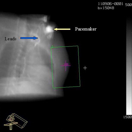 Figure 2.  Digital Reconstructed Radiograph (DRR) showing the pacemaker and the leads in relation to the radiation beam.