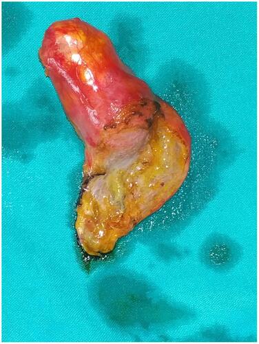 Figure 3 Inflamed deformed gallbladder after resection.