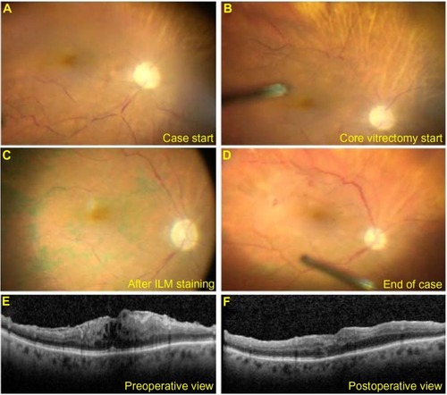 Figure 1 Intraoperative view of optic nerve and macular ischemia in Case 1 patient.