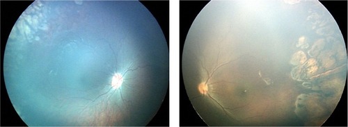 Figure 3 A male infant who was born at 31 weeks’ gestation and of birth weight 1.200 g. OU: ROP stage 2, zone 2, with disease. Regression of retinopathy of prematurity after laser treatment. Refraction at 61 months of age. OD, −2.50 D/−1.00 D, axis 0 degrees; OS, −4.75 D/−2.25 D, axis 180 degrees.