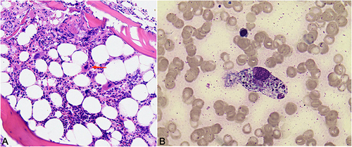 Figure 2 Bone marrow examination: active bone marrow hyperplasia, normal granulocyte lines with reactivity changes, elevated red blood cell lines, normal megakaryocyte lines, and observed tissue hemophagocytosis. (A) Bone marrow pathology (HE staining, ×80): bone marrow cells phagocytosis of nucleated red cells (as shown by arrow). (B) Bone marrow cytology (Reye’s staining, ×100 oil mirror): bone marrow cells phagocytosis of granulocytes and nucleated red cells.