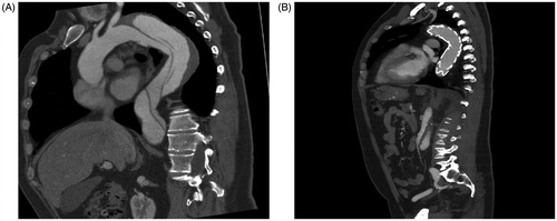 Figure 3. The placement of a stentgraft covering the entry tear in type B dissection will promote remodeling of the aortic wall, particularly in the proximal part with predisposition for late dilatation. (A) Morphology of dissected aortic wall. (B) Remodeling of the aorta after placement of stentgraft.