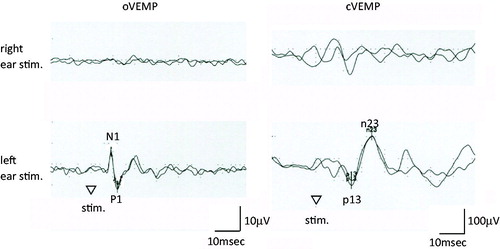 Figure 2. VEMP findings. 500 Hz short tone bursts (air-conducted, 125 dBSPL). cVEMPs were recorded on the sternocleidomastoid muscle ipsilateral to the stimulated ear, while oVEMPs were recorded just below the lower eye lid contralateral to the stimulated ear. Both of cVEMP and oVEMP were absent to the right ear stimulation (air-conducted 500 Hz short tone bursts, 125 dBSPL).