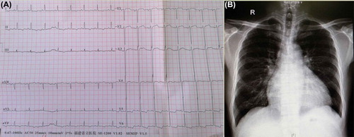 Figure 1. (A) Twelve-lead electrocardiogram showing sinus rhythm, PTFV1 ≥ 0.04 mm s, TavL flat, TavF inversion, TV4–6 bidirectional, STV5–6 depression. (B) Chest X-ray showing cardiomegaly (cardiothoracic ratio 57.4%).
