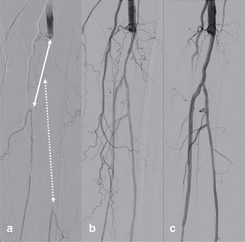 Figure 6 Example of infrapopliteal angioplasty and stenting for critical ischemia. (a) Angiogram of infrapopliteal arteries of a 79-year-old diabetic male with left leg critical limb ischemia (nonhealing heel ulcer). Note the long occlusions of the tibioperoneal-posterior tibial (white straight line) and peroneal (white dotted line) arteries. (b) Angiograms after initial balloon angoplasty and (c) after additional drug-eluting stenting (CYPHER Drug-eluting stent, Cordis, Waterloo, Belgium) show successful recanalization of both arteries to the distal foot. The patient experienced immediate relief of rest pain and the ulcer healed gradually within three months.