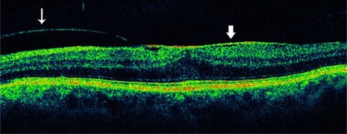 Figure 18 Partial posterior vitreous detachment and epiretinal membrane.