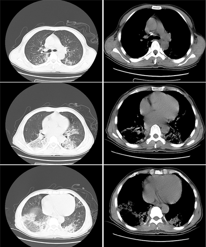 Figure 2 CT image of the chest after three weeks the treatment of pneumonia caused by Chlamydia abortus.