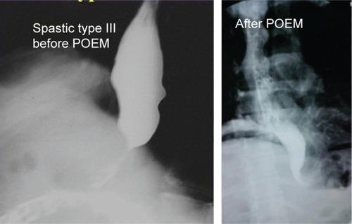 Figure 3 Esophagogram of a 56-year-old female with achalasia type III before and after anterior POEM. Rapid passage of the contrast medium after POEM.