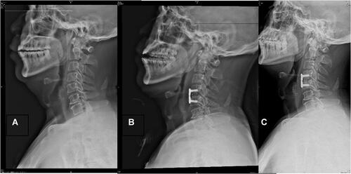 Figure 2 Typical case in the Skyline group. The patient was diagnosed with cervical spondylosis. (A–C) Anterolateral view of the cervical spine preoperatively, postoperatively, and at the last follow-up. Before the surgery, the patient had a smaller C2-C7 Cobb angle and a larger C2-C7 SVA. After the operation, the C2-C7 Cobb angle and the C2-C7 SVA were restored immediately, and pain and neurological symptoms were significantly relieved. Meanwhile, slight loss of C2-C7 Cobb angle and C2-C7 SVA correct was observed at the last follow-up.