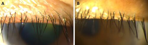 Figure 3 Slit-lamp photograph of waxy debris, appeared as lipid on eyelid margin and base of eyelashes.