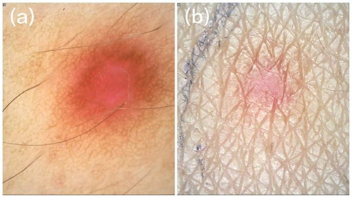 Figure 2 Dermoscopic findings. The center of the lesion showed a red homogeneous pattern surrounded with a brown pigment network. (a) polarized light, (b) non-polarized light.