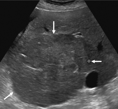 Figure 5 US LI-RADS Category 3 observation in a 70-year-old female with cryptogenic cirrhosis undergoing US surveillance.
