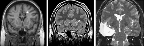 Figure 4 Comparison of stereotactic ablation with temporal lobectomy. Coronal magnetic resonance images following radiofrequency cingulotomy (left), radiofrequency capsulotomy (center), and temporal lobectomy for temporal lobe epilepsy (right). The lesions and resection area are marked by an arrowhead in each case. The extremely small size of the stereotactic lesions when compared to the extensive temporal lobe resection can be appreciated.