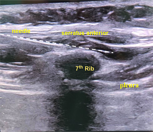 Figure 1 Sonographic anatomy of the low serratus anterior plane block. 7th rib, the seventh rib.