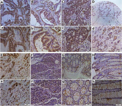 Figure 2. IHC staining for POM121 expression in colorectal samples. (a),(b)Positive IHC staining of POM121 in well-differentiated adenocarcinoma. (c), (d)Positive IHC staining of POM121 in moderately differentiated adenocarcinoma. (e), (f)Positive IHC staining of POM121 in poorly-differentiated adenocarcinoma.(g), (h) Negative IHC staining of POM121 in normal colorectal tissue. (Original images×4, scale bars500 μm; enlarged images×40, scale bars 50 μm).