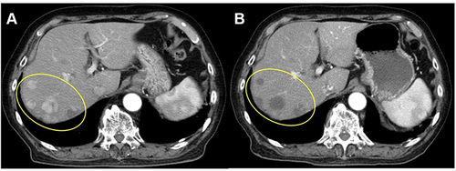 Figure 3 Arterial phase contrast-enhanced computed tomography images in a patient with a partial response. (A) Image obtained before treatment showing five viable lesions within the yellow oval. (B) Image obtained 1 month after treatment showing complete necrosis of three lesions and partial necrosis of two lesions.