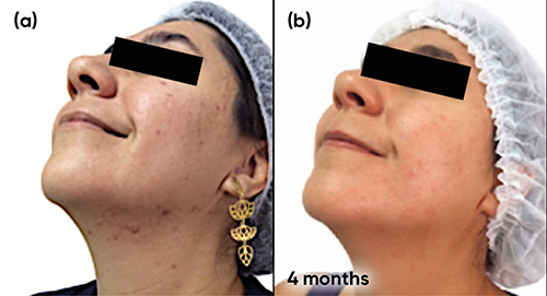 Figure 11 Case study 5 improvement on left-hand side of face, baseline to 4 months (a) Baseline (b) 4 months with oral contraceptive (ethinylestradiol plus chlormadinone) plus AZA 15% gel twice a day.