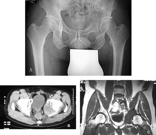 Figure 1. Plain radiograph (A), CT scan (B) and MRI scan (C) of patient's pelvis, showing a destructive bony metastasis involving the left acetabular region.