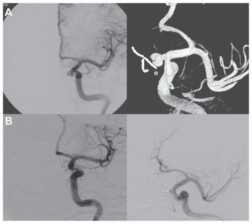 Figure 3 (A) Internal carotid artery angiography demonstrating the pseudoaneurysm originating near the inferior meningohypophyseal trunk and the microcottonoid adhering to the internal carotid artery fissuration (white asterisk). (B) Exclusion of the pseudoaneurysm after the endovascular treatment.