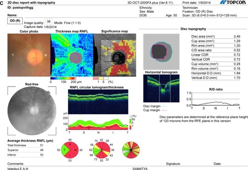 Figure 1 (A) The image of a GCC scan which is centered 1 mm temporal to the fovea and covered a square grid on the central macula. (B) The OCT image showing ILM, IS/OS, RPE, and BM. (C) The postoperative OCT image of a patient showing retinal nerve fiber layer, ILM and IS/OS, and optic nerve head parameters.