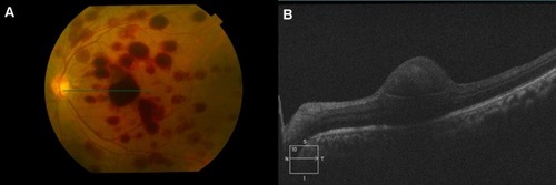 Figure 1 (A) Fundus photograph showing superficial and deep retinal hemorrhages over the posterior pole. (B) Spectral domain optical coherence tomogram of macula showing sub-ILM (internal limiting membrane) bleed over fovea.