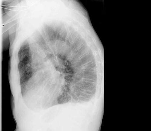 Figure 1 Lateral projection of a chest radiograph.