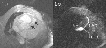 Figure 1. a) Precontrast 3D TrueFISP localizer of the left anterior descending (LAD) coronary artery (black arrows) of a swine. b) Coronary system of the same animal following IA injection of diluted contrast agent through a percutaneously placed catheter. Both the LAD and the circumflex arteries are visible, as well as several marginal arteries.