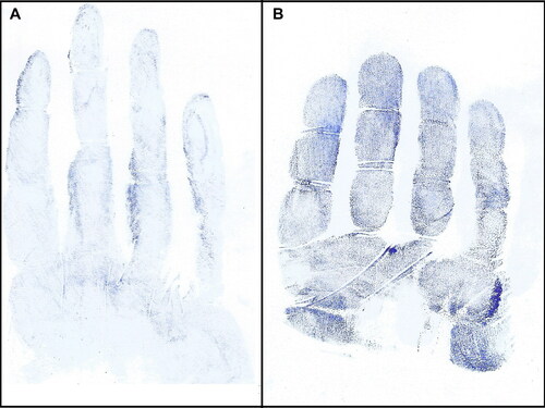 Figure 5. Impression marks from a gloved flat hand (A) and a gloved hand grasping an object 8 cm in diameter (B), in which well-demarcated phalangeal creases are evident in the right impression mark.