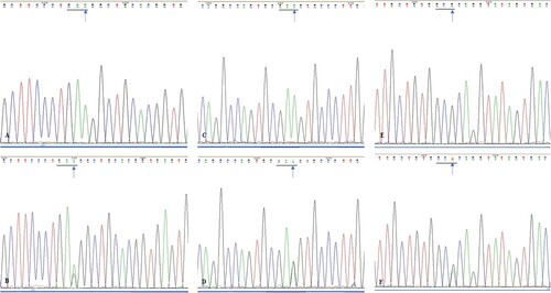 Figure 3. (A). Sequencing analysis of exon 2 of SMO gene in wild type ameloblastoma specimens; (B). Sequencing analysis of exon 2 of SMO gene in mutated ameloblastoma specimens (blue arrow, GAA→GAG); (C). Sequencing analysis of exon 3 of SMO gene in wild type ameloblastoma specimens; (D). Sequencing analysis of exon 3 of SMO gene in mutated ameloblastoma specimens (blue arrow, GAA→GAG); (E). Sequencing analysis of exon 5 of SMO gene in wild type ameloblastoma specimens; (F). Sequencing analysis of exon 5 of SMO gene in mutated ameloblastoma specimens (blue arrow, GCG→GCA).