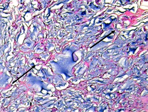 Figure 4 Histological photo of Bulkamid® traversed by a fine network at 14 months consisting of strands of fibrous tissue containing fibrous cells, blood vessels and a few macrophages (arrows), H&E ×600.