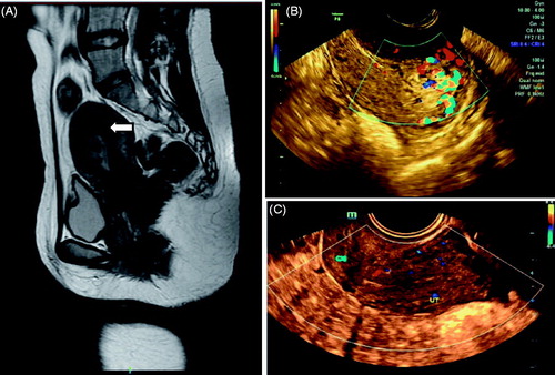 Figure 2. Retained placenta accreta marked vascularity after abortion. (A) MRI showed the retained placenta accreta as irregular low signal intensity; (B) Ultrasound before operation: 32 mm × 20 mm × 19 mm hyperechogenic shadow in the endometrial cavity with patchy blood flow signal, and unclear boundary with the muscular layer of the uterus was shown; (C) The lesion was not seen at 1 month after operation.