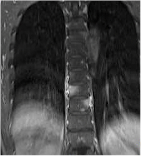 Figure 3 MRI of the thoracic spine shows abnormal signal lesions in the 5th, 8th, 9th, and 10th thoracic spine (T5, T8, T9, and T10).