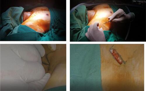 Figure 2 The 3-cm skin incision in right armpit of the patient.