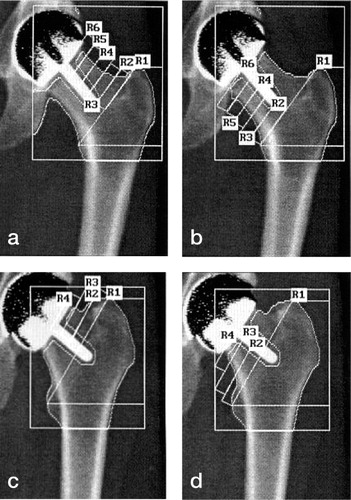 Figure 2 Examples of DEXA scans with BHRs in situ. Figures 2a and b are in the same patient, with 10 femoral neck ROI, and Figures 2c and d are from another patient, who had 6 ROIs.