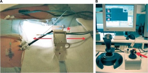 Figure 3 “QuickCAS” Cardiodrive system positioned in the patient’s groin making it possible to advance the catheter by means of either the keyboard or, as above, a joystick (single arrow).