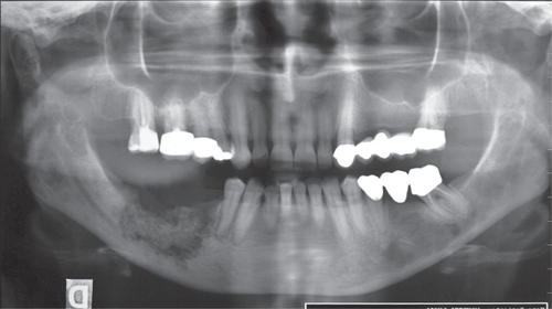 Figure 1 Osteolytic lesion in the lower jaw of patient treated with Zometa® for 12 months (59 years old, female, breast cancer).