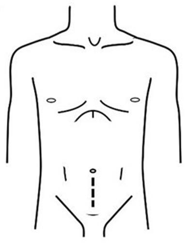 Figure 1 Incision of open radical prostatectomy.