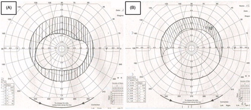 Figure 2. Preoperative (A) and postoperative (B) diplopia fields. The preoperative diplopia field showed superior and inferior vertical diplopia of approximately 30° (A), and the postoperative diplopia field showed recovery of the superior diplopia to approximately 10° (B).