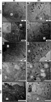 Figure 2 Transmission electron microscopy images demonstrating the internalization of AuNPs-PAA-Ctxb in A431 cells (A and B), MDA-MB-453 cells (C and D), HK-2 cells (E and F), THLE-2 cells (G and H) and TIME cells (I and J). The cells were exposed to 5.0 µg Au/mL of AuNPs-PAA-Ctxb for 3 h (left column) or 24 h (right column). Arrows indicate AuNPs-PAA-Ctxb. Images were acquired at different magnifications. Size bar =1 µm, N = Nucleus.Abbreviations: AuNPs-PAA-Ctxb, polyallylamine-coated gold nanoparticles conjugated to Cetuximab; A431, human epidermoid cancer cells; HK-2, human kidney cells; MDA-MB-453, human breast cancer cells, THLE-2, human liver cells; TIME, human telomerase immortalized microvascular endothelial cells.