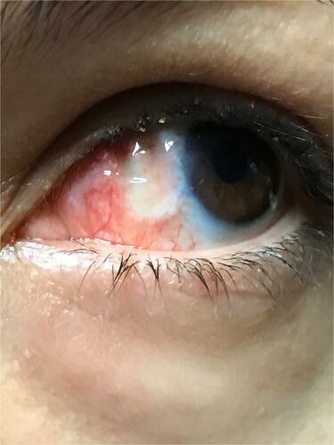 Figure 1 Example of a patient at post-operative day 1 results, notice the contact bandage lens and healing conjunctival graft.