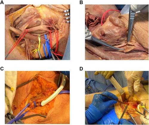 Figure 2 Training in operative anatomy. (A) Trauma neck exploration. (B) Carotid Endarterectomy. (C) Femoral-popliteal bypass graft proximal exposure proximal anastomosis. (D) Femoral-popliteal bypass graft distal exposure with distal anastomosis.