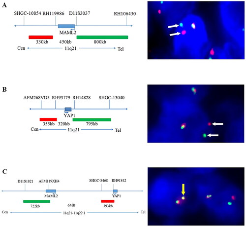 Figure 2. The characteristics of probes and representative results of the FISH analysis. The labelling of the dual-colour break-apart probes MAML2 (A) and YAP1 (B) and the fusion probe YAP1–MAML2 (C), respectively, with corresponding representative positive cells in FISH analysis. The white arrows represent separate signals, while the yellow arrows represent fusion signals.