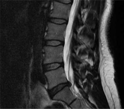 Figure 1. Sagittal magnetic resonance image of an L5/S1 disc herniation in the setting of degenerative disc disease. The patient was a 41-year-old woman with a six-week history of right-sided radicular leg pain in an S1 nerve root distribution. The patient failed conservative treatment, including physical therapy and pain management. Her symptoms were successfully relieved with a right-sided L5/S1 microdiscectomy.