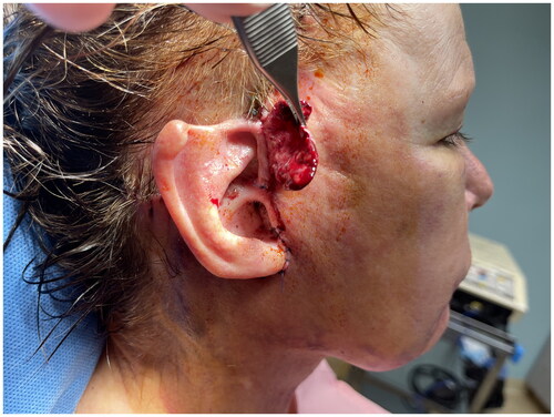 Figure 2. A random pattern flap of retained cheek skin measuring 3.5 × 2.5 cm was elevated and later dressed with antibiotic ointment and gauze to ensure viability and promote maturation for a period of approximately two weeks between stages 1 and 2 of procedure.